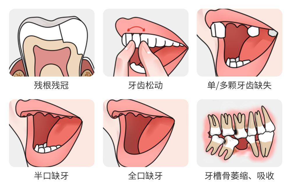 適用於所有人群,口腔衛生狀況,牙齒形態,面型等