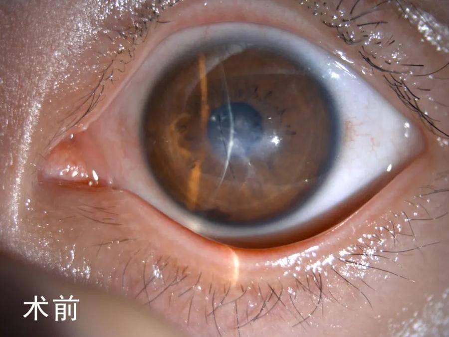 江苏13岁圆锥角膜患者来鲁求医,省眼速度助其恢复良好视力
