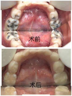 寶寶牙不好怎麼辦?_兒童_口腔_治療