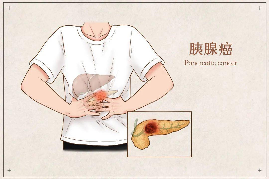健康提醒 || 警惕胰腺癌,留意这四个预警信号_治疗_肿瘤_患者