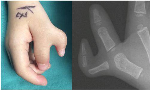 科普时间 | 先天性拇指多指畸形,看广妇儿"吴"分型_临床_指骨_平面