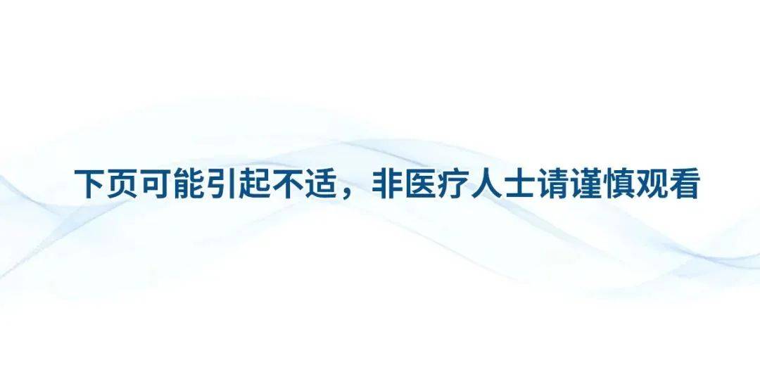 宣武有術|後路聯合極外側入路顱頸交界脊索瘤切除 頸椎四棒系統固定