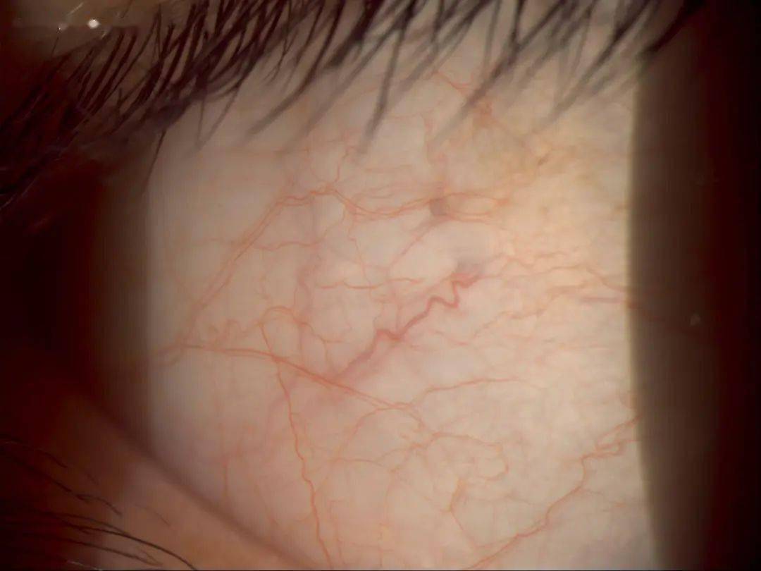 裂隙灯显微镜 | 常用检查方法图文高清对照版_角膜_照明_组织