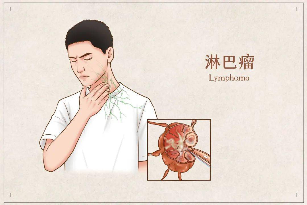 【友誼科普】關注健康,關注淋巴瘤_治療_淋巴結_惡性