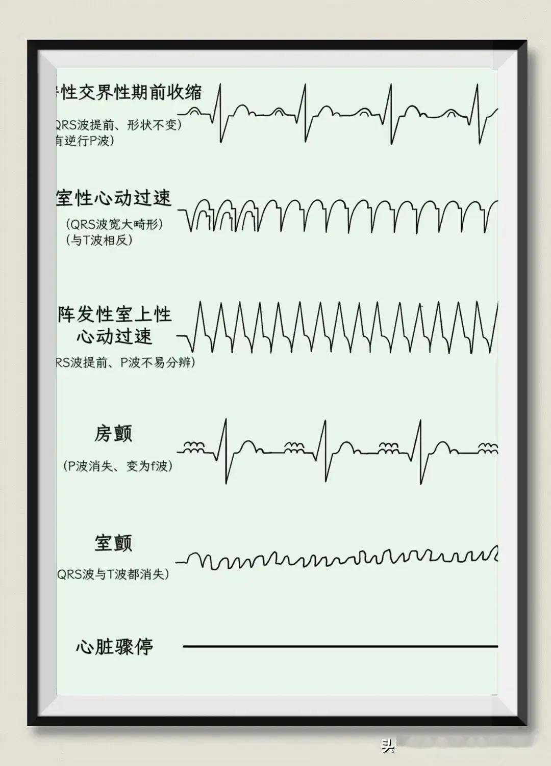 早搏的心电图表现图片