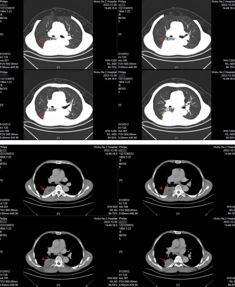 222-12-30胸部ct:右下肺佔位.