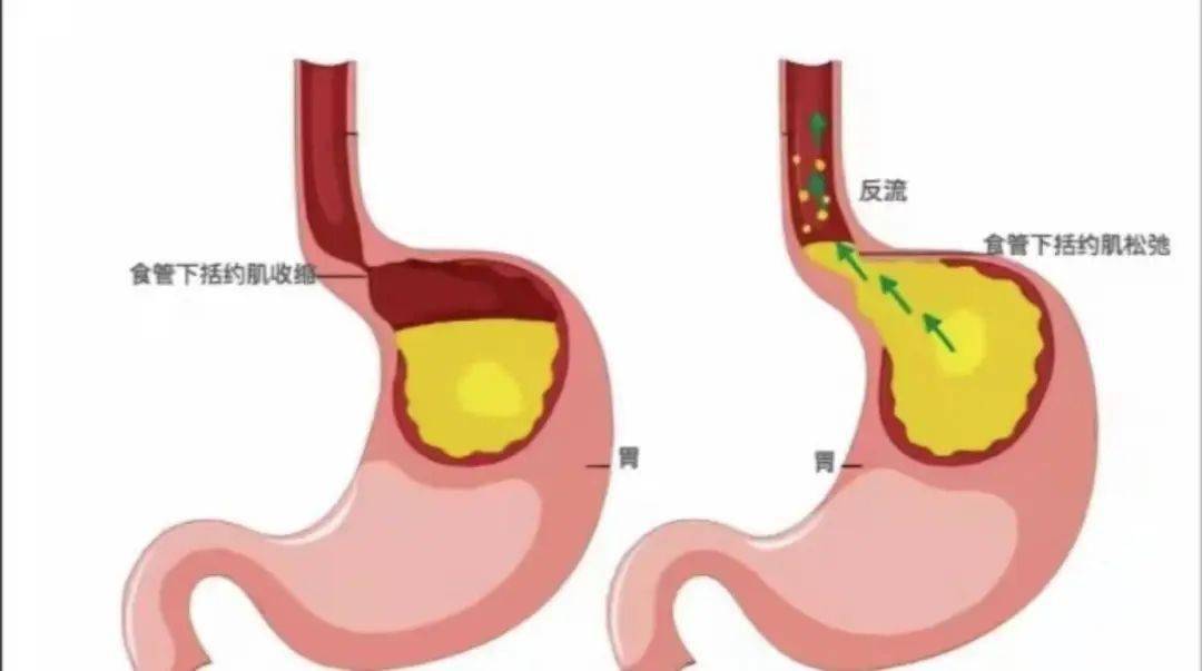 胃酸倒流"烧心"怎么办?5个原因3种方法要记住,别再轻易忽视