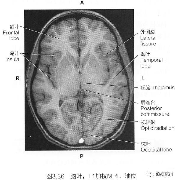 每側大腦半球的皮質可以分為4個腦葉:額葉,頂葉,枕葉和顳葉.