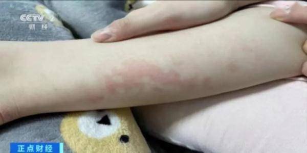 广州频频有人中招!医生紧急提醒_皮肤_热水袋_低温