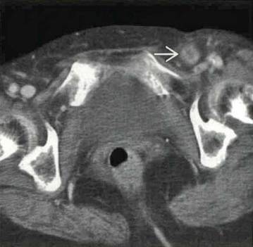 2,半月线疝(斯皮格尔疝),结肠经左侧腹直肌旁的腹壁缺口疝出,贴附于腹