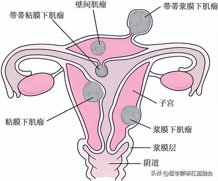 卵巢腫瘤對於有手術指徵的良性腫瘤或非贅生性卵巢囊腫