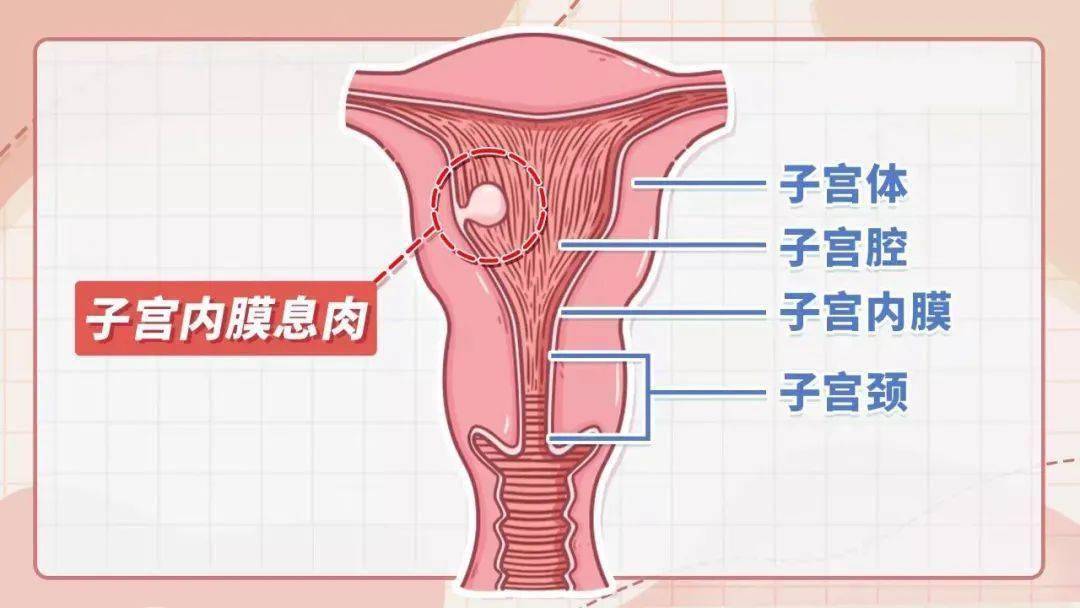 3mm稍高回声,边界清楚,形态规则,这个类似于蘑菇样的赘生物就是子宫