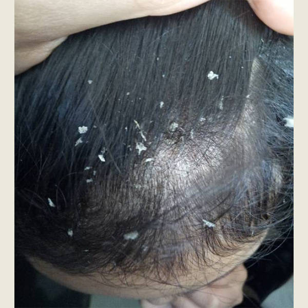 去屑止痒洗发水排行_头发_头皮屑_问题