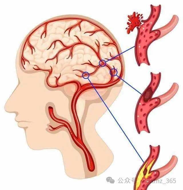 冬季心腦血管疾病高發 醫生:吃飯別太快,別太飽_食物