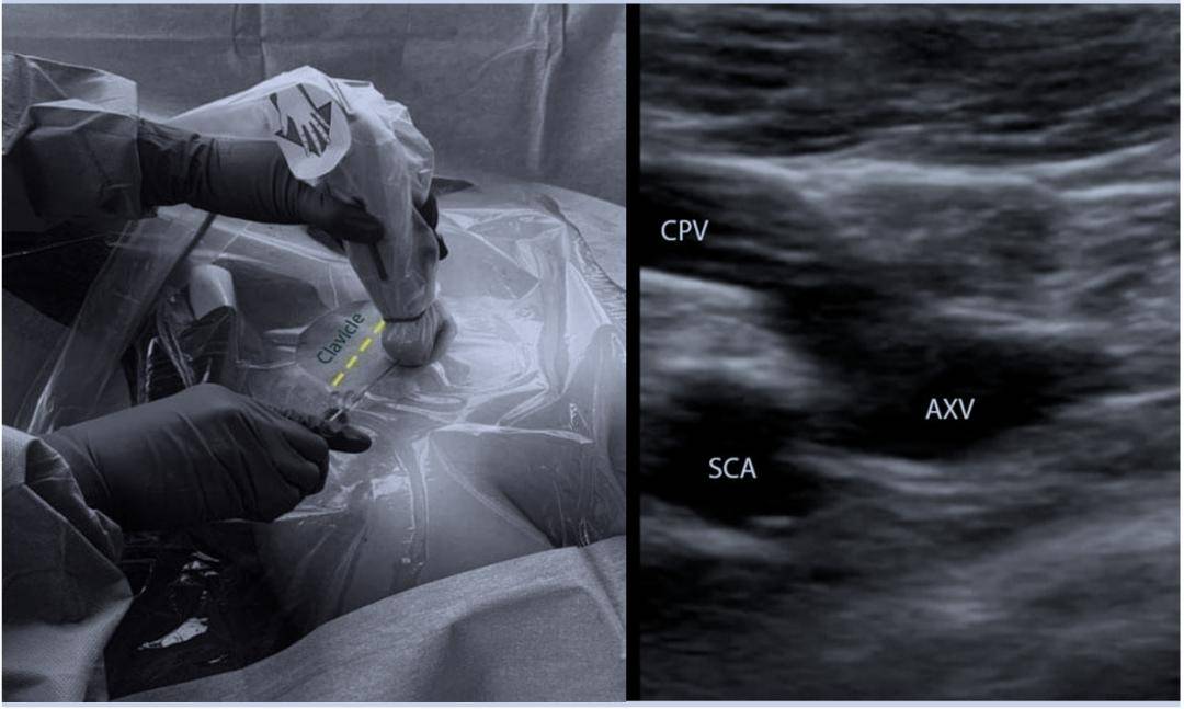 操作技巧 | 超声引导下锁骨下静脉穿刺