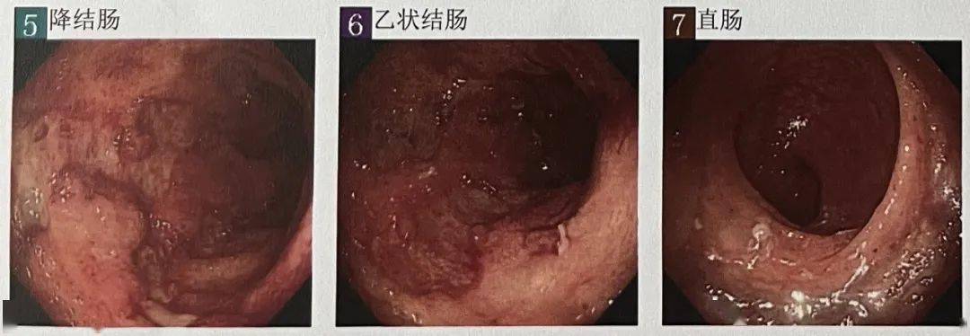 腸鏡下可見橫結腸-直腸瀰漫性糜爛及大小不等的潰瘍,部分潰瘍呈深鑿樣