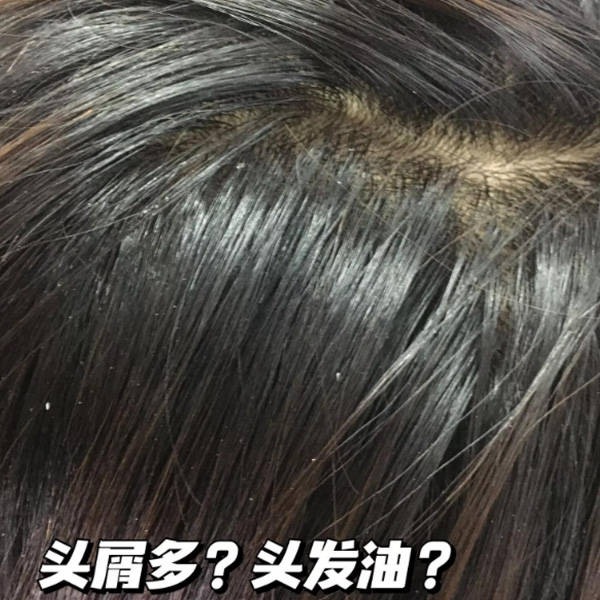 頭皮問題產生原因彙總:頭皮屑和頭癢通常是由頭皮的生理和病理變化