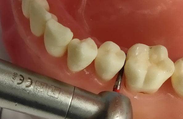 高效,快速——邻面去釉车针_操作_修整_抛光