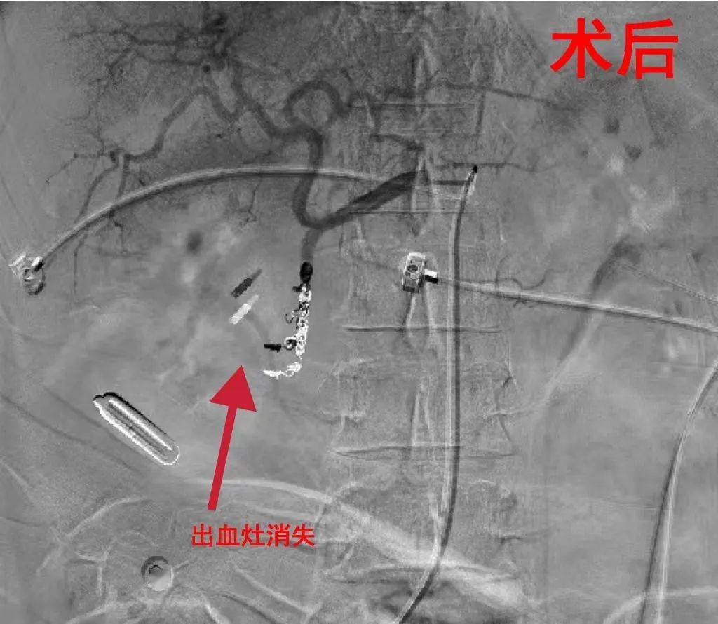 介入團隊術中造影發現,其十二指腸球部潰瘍處見大量造影劑經破口外滲