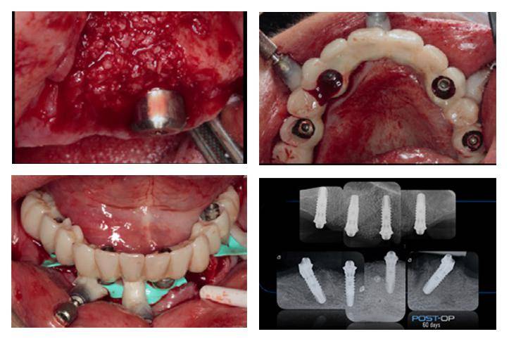 【病例分享】数字化全口无牙颌种植修复治疗方案_模型_mock-up_设计