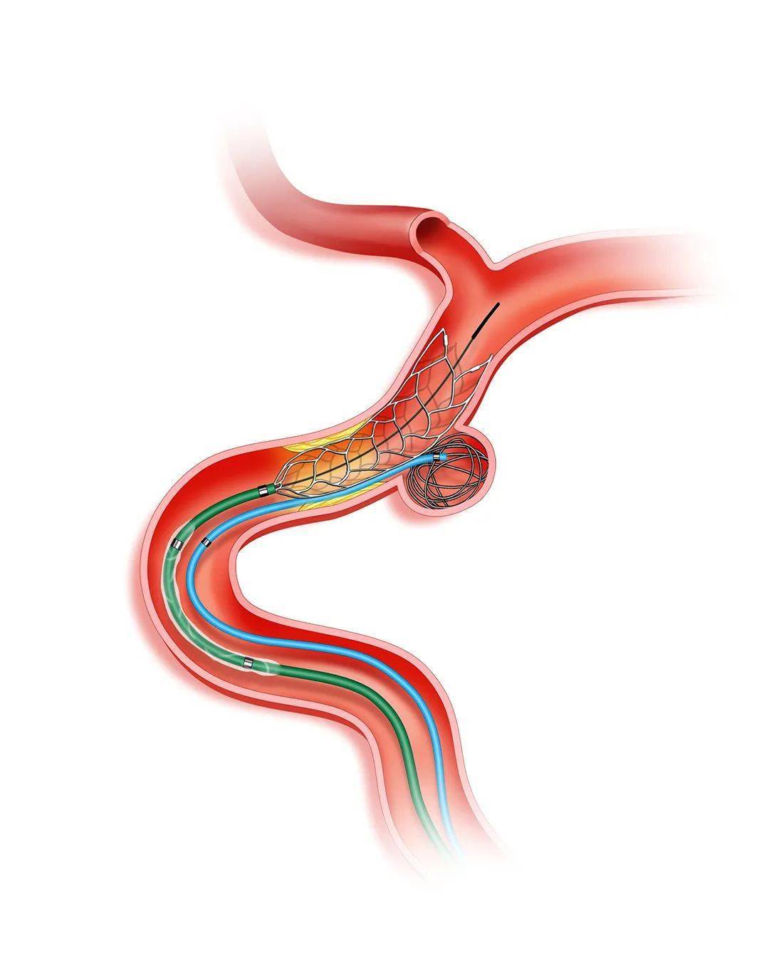 锦囊妙技|answer技术治疗动脉瘤合并狭窄操作步骤详解_栓塞_扩张_支架