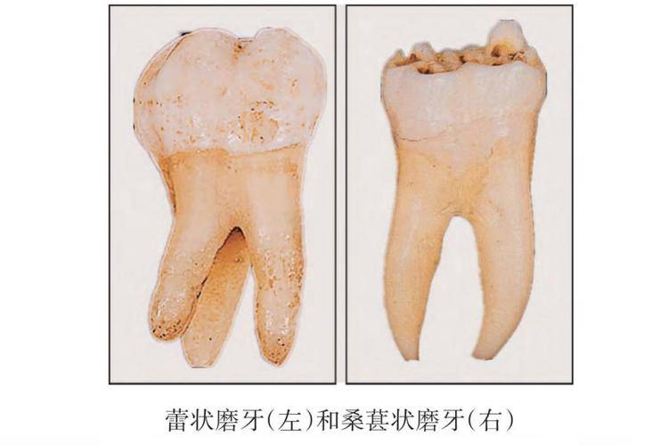 梅毒牙齿半月形的图片图片