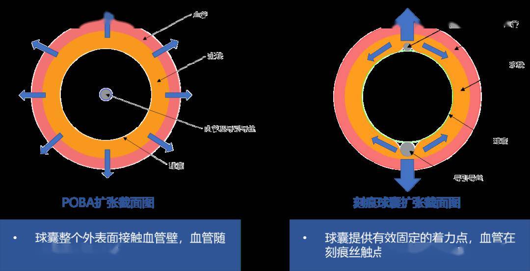 刻痕球囊图片