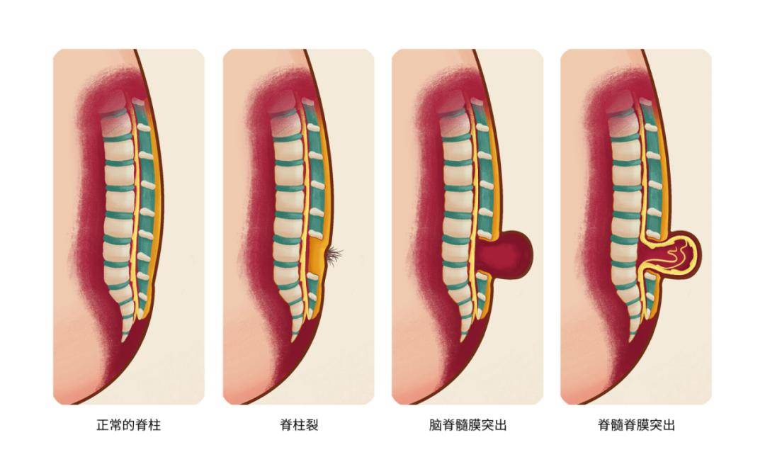 小儿脊髓栓系图片图片