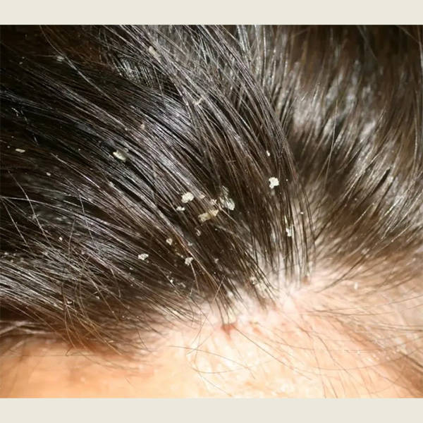 头皮问题产生原因如下:头屑和头皮红疹产生的原因多种多样