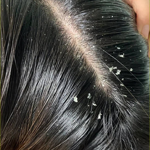 洗发水止痒控油推荐_头皮_成分_油脂