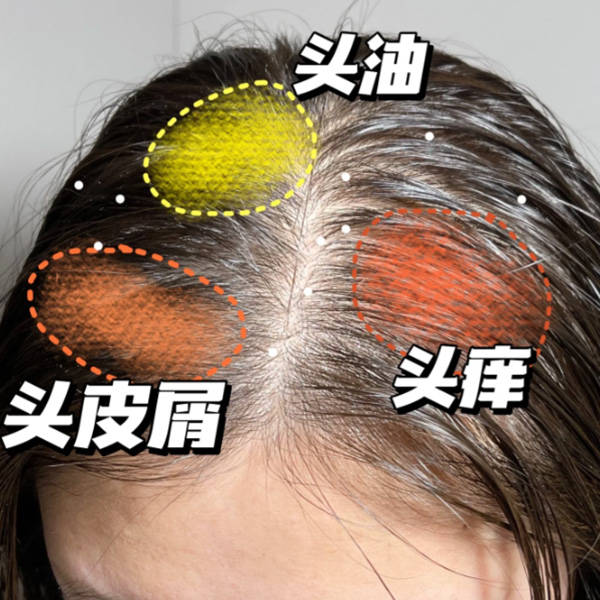 二硫化硒洗头的危害图片