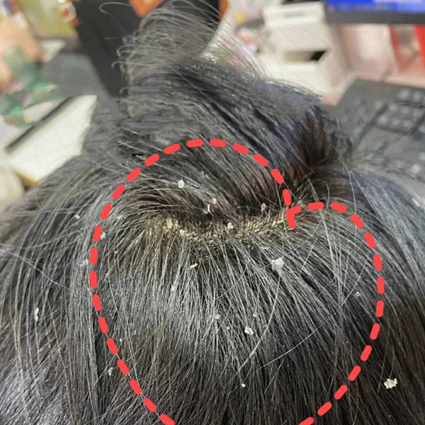 头发长头皮屑用什么洗发水?洗头膏止痒去屑控油推荐