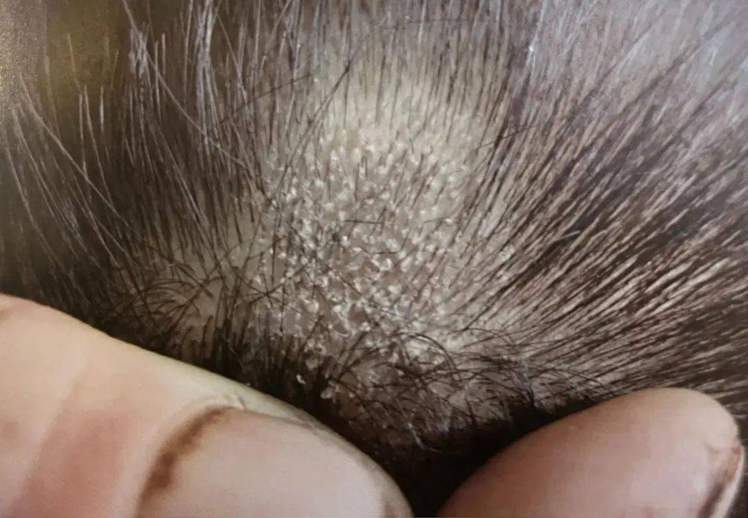 股癣,灰指甲,脚气……被真菌感染后不及时治疗会怎样?_医生_皮肤_诊断