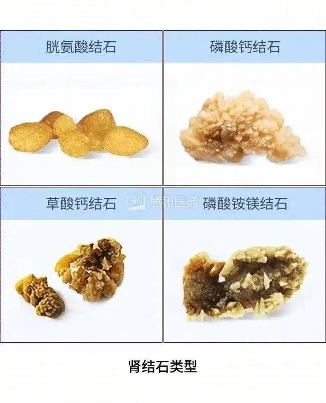 尿结石严重吗图片