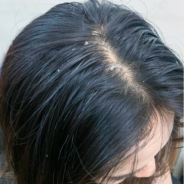 马拉色菌是一种天然存在于头皮上的真菌,当其过度繁殖时,可能导致油脂