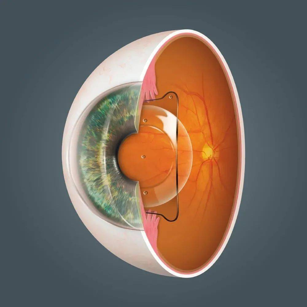 人群_角膜_晶体