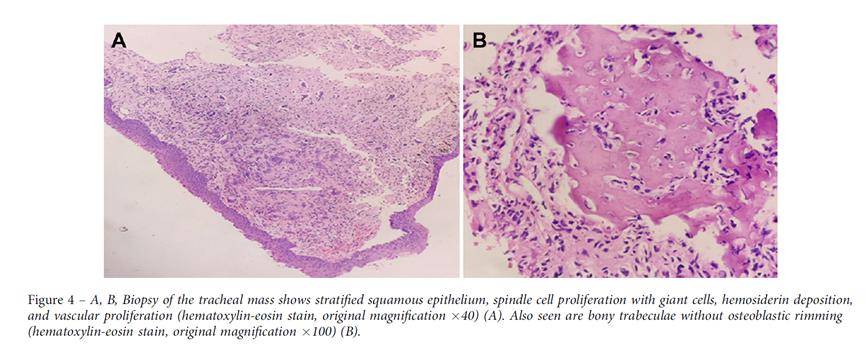 有出血区域和骨小梁,没有成骨细胞边缘(图 4a,4b).