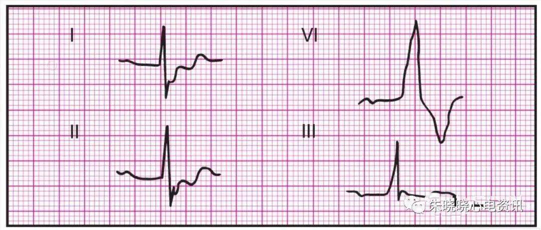 14种异常心电图的临床特点