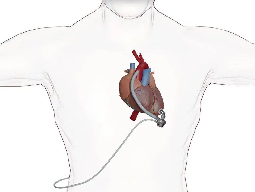 新一代超小型长期人工心脏获批上市_eva-pulsar_辅助_产品