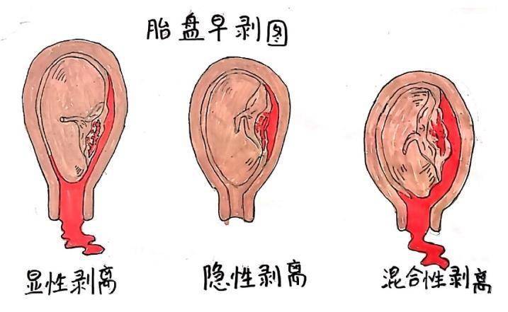 胎膜与胎盘关系图片图片