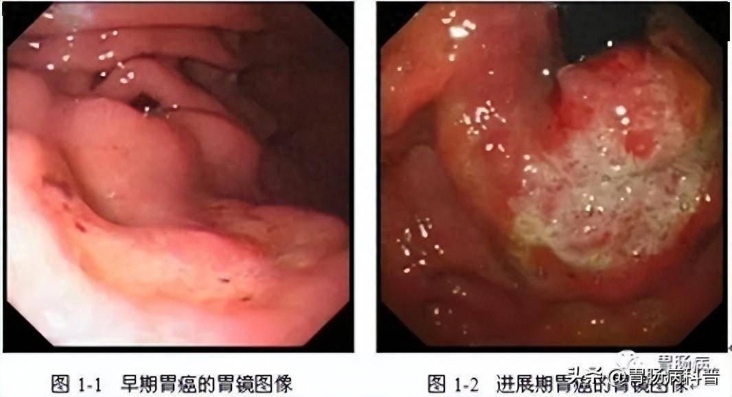 慢性胃病,一旦出现这7种症状,多半已经癌变!