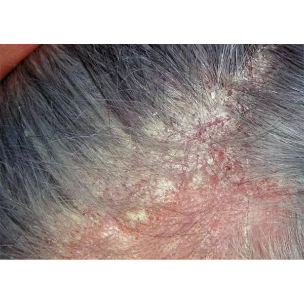 排名前十洗发水_头皮_头发_问题