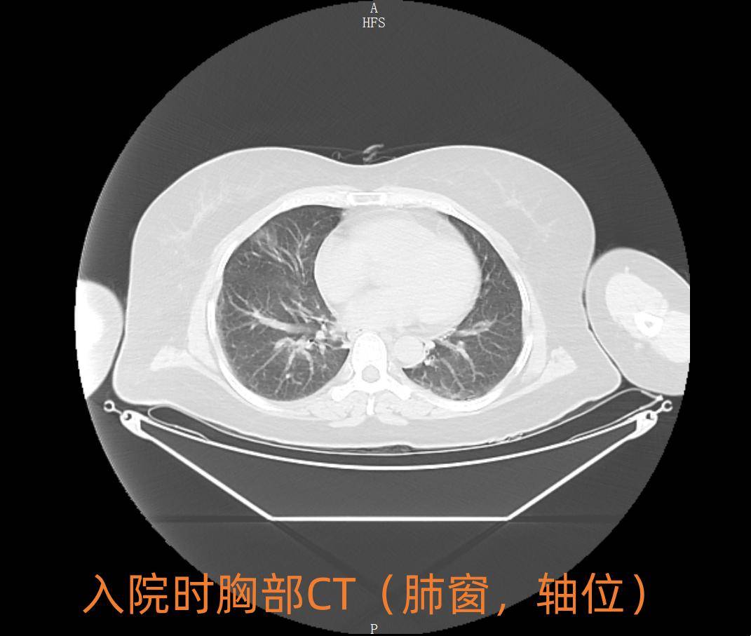 纵隔窗和肺窗图片