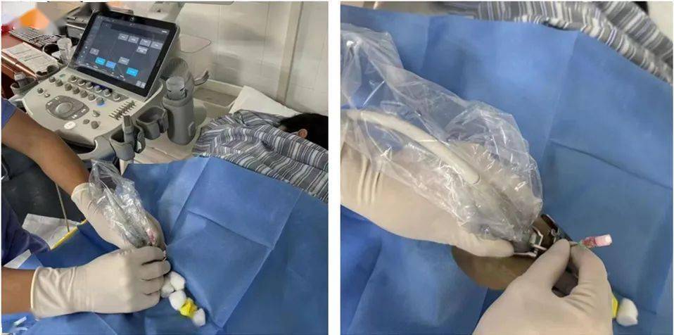 肾脏彩超中"肾脏无回声病灶"是什么?_超声_治疗_引导