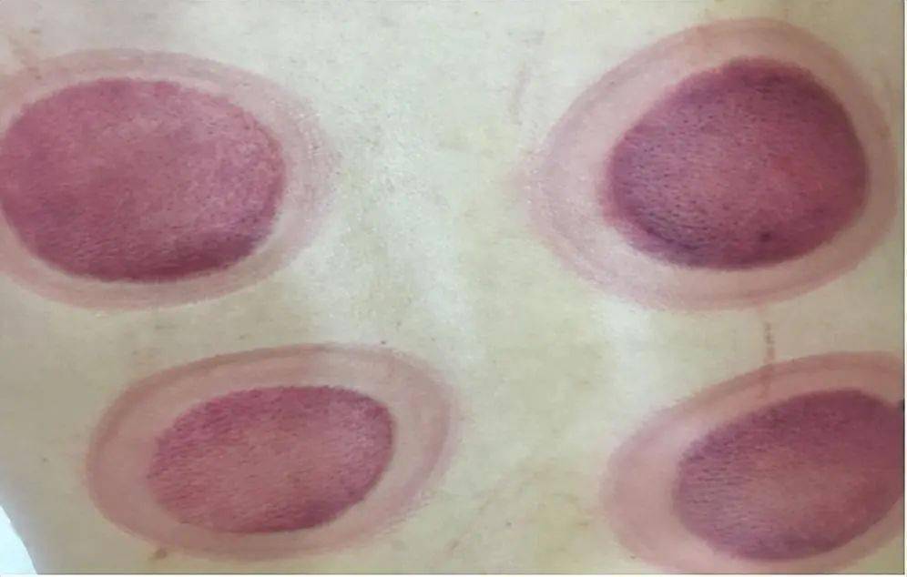 拔罐真的能治病?拔出来黑,紫,青,红各色的罐印都说明什么?