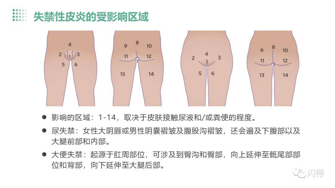 【ppt】失禁性皮炎患者的护理