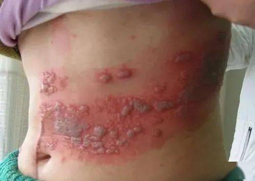 治疗"蛇盘腰" 民间中医绝技!(收藏备用)_病变_部位_方法