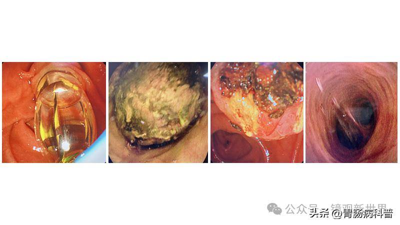 1例胆囊结石的超级微创治疗_患者_病史_腹部