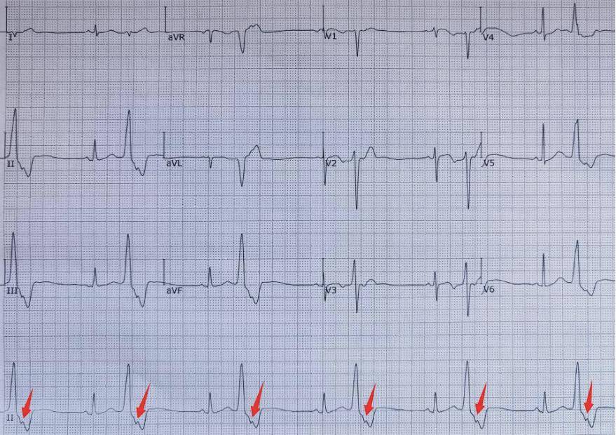 多源性房性早搏心电图图片