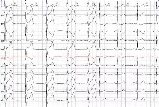 牢记10 个心电图诊断特征,快速鉴别心律失常!_心房_窦性_心室